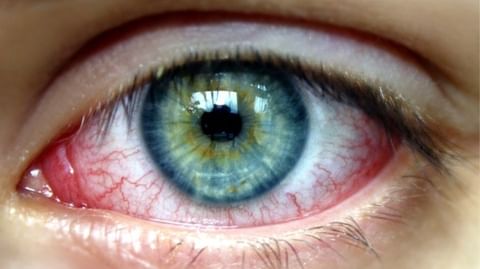 Occhio secco. Che cos'è?